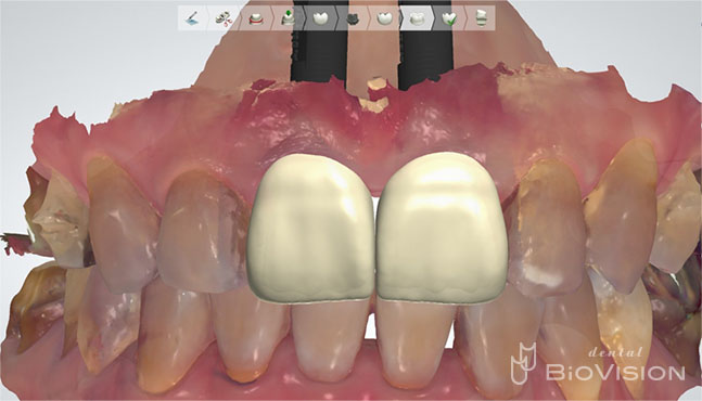 Screw Retained Layered Zirconia & 3D Printer Model