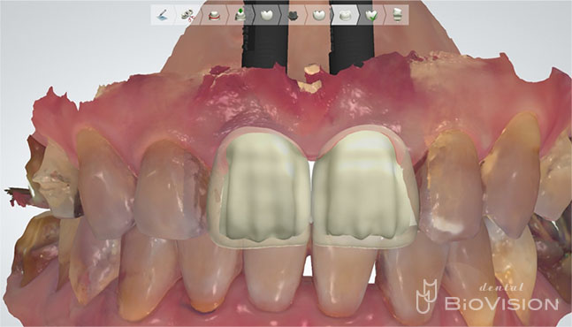 Screw Retained Layered Zirconia & 3D Printer Model