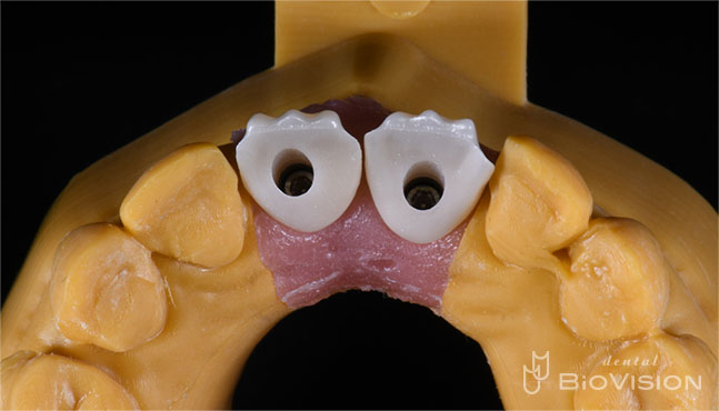 Screw Retained Layered Zirconia & 3D Printer Model