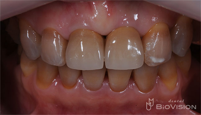 Screw Retained Layered Zirconia & 3D Printer Model