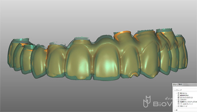 Screw Retained Zirconia Ceramic with Pink Porcelain Upper and Lower