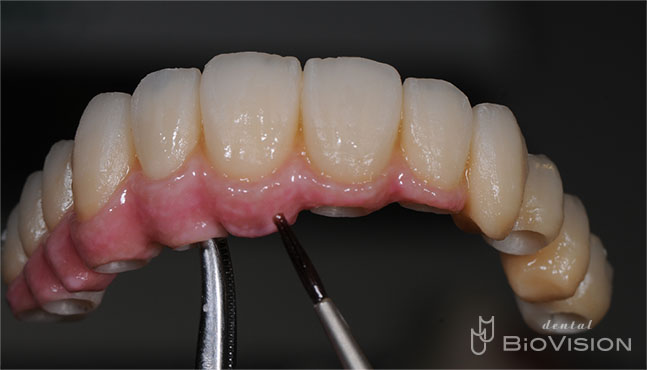 Screw Retained Zirconia Ceramic with Pink Porcelain Upper and Lower