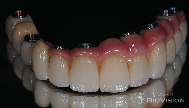 Screw Retained Zirconia Ceramic with Pink Porcelain Upper and Lower
