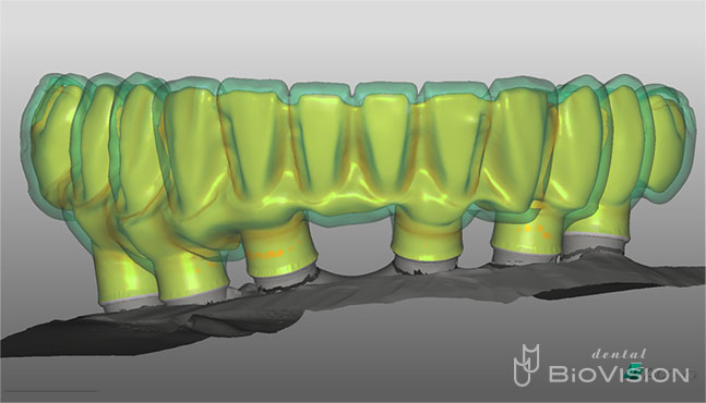 Screw Retained Zirconia Ceramic with Pink Porcelain Upper and Lower