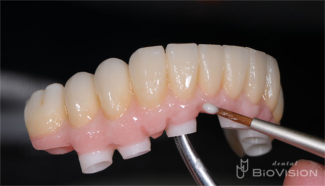 Screw Retained Zirconia Ceramic with Pink Porcelain Upper and Lower