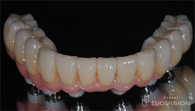 Screw Retained Zirconia Ceramic with Pink Porcelain Upper and Lower