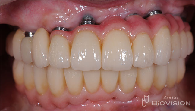 Screw Retained Zirconia Ceramic with Pink Porcelain Upper and Lower