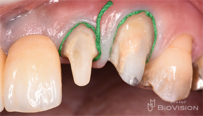 6 Front tooth screw retain superstructure and natural tooth prosthesis