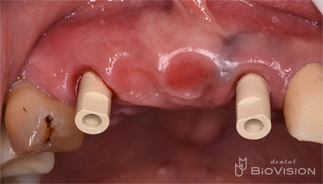 6 Front tooth screw retain superstructure and natural tooth prosthesis