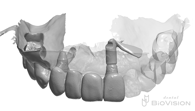 6 Front tooth screw retain superstructure and natural tooth prosthesis