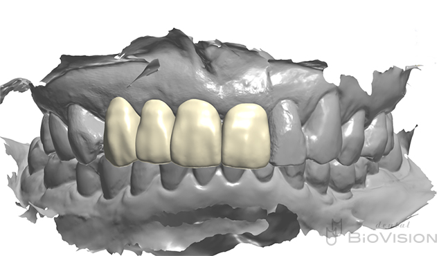 6 Front tooth screw retain superstructure and natural tooth prosthesis