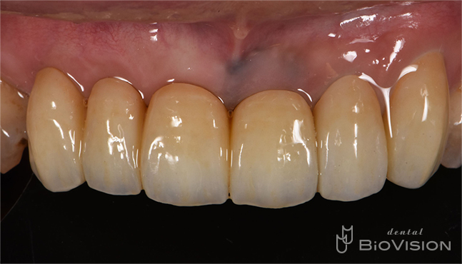 6 Front tooth screw retain superstructure and natural tooth prosthesis