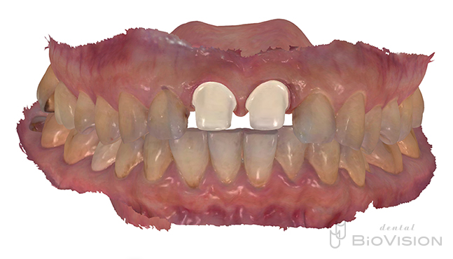 11&21 single Monolithic Zirconia Cr