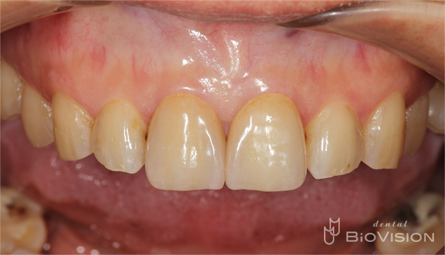 11&21 single Monolithic Zirconia Cr