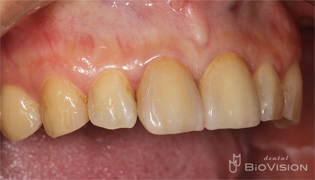 11&21 single Monolithic Zirconia Cr