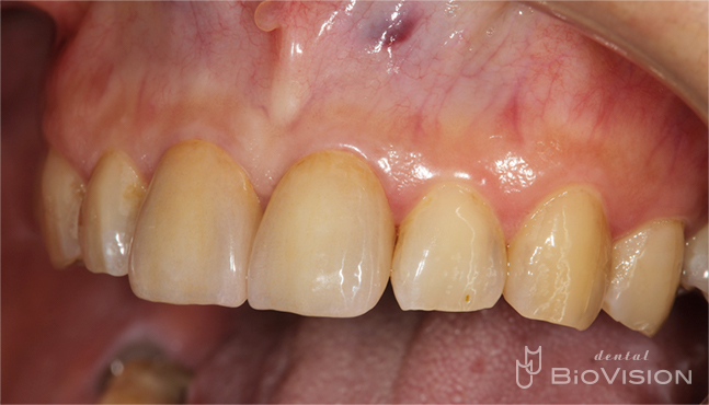 11&21 single Monolithic Zirconia Cr