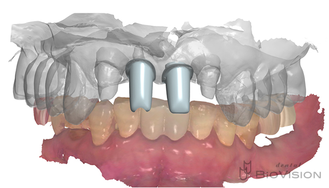 Cement retain superstructure and monolithic zirconia crown