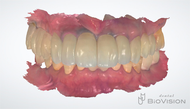 Cement retain superstructure and monolithic zirconia crown