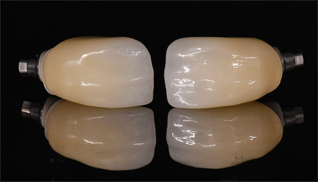 Cement retain superstructure and monolithic zirconia crown