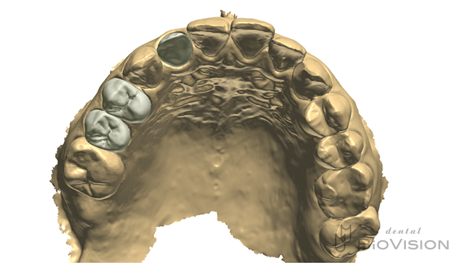 Layering Zirconia & Monolithic Zirconia