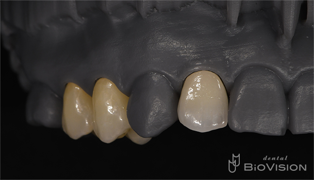 Layering Zirconia & Monolithic Zirconia