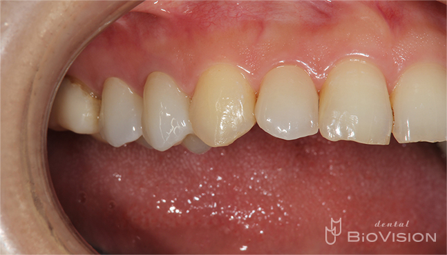 Layering Zirconia & Monolithic Zirconia