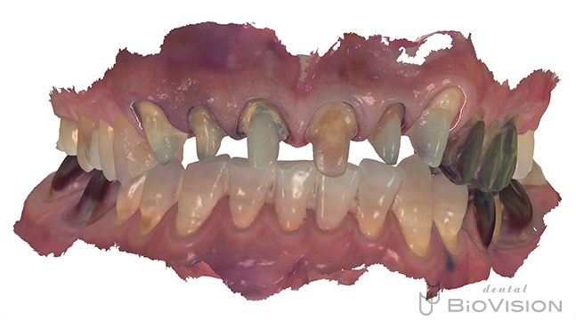 Maxillary 6 anterior teeth monolithic zirconia crown