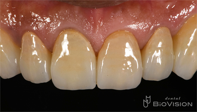 Maxillary 6 anterior teeth monolithic zirconia crown