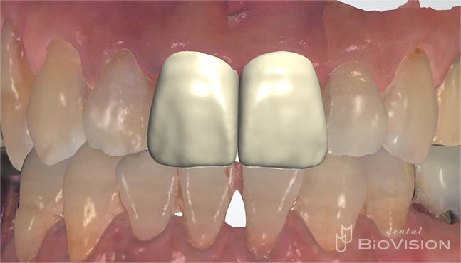 Maxillary anterior screw retain monolithic zirconia