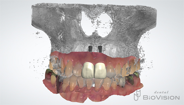 Maxillary anterior screw retain monolithic zirconia