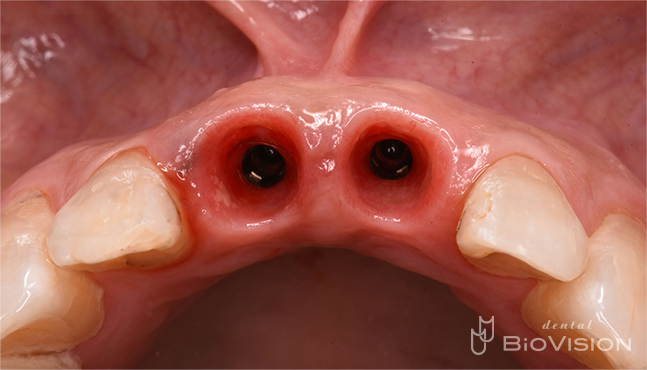 Maxillary anterior screw retain monolithic zirconia