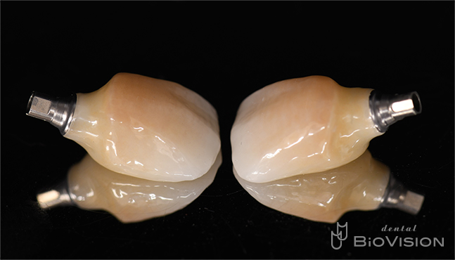 Maxillary anterior screw retain monolithic zirconia