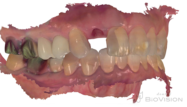 Maxillary anterior tooth cement retain monolithic zirconia