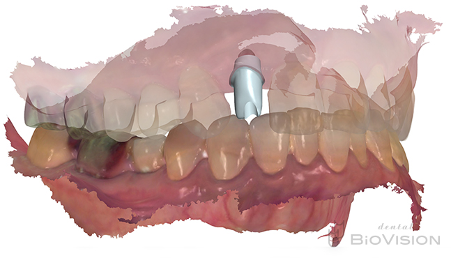 Maxillary anterior tooth cement retain monolithic zirconia