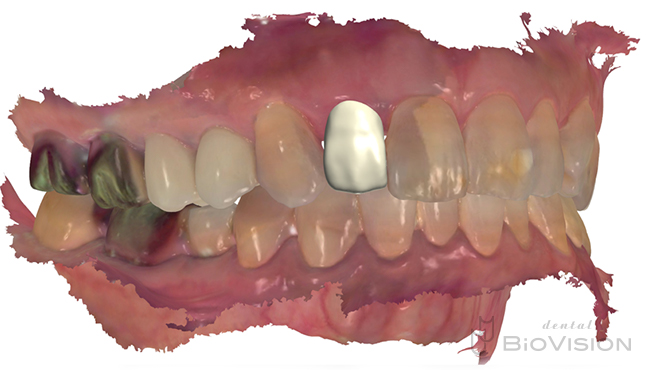 Maxillary anterior tooth cement retain monolithic zirconia