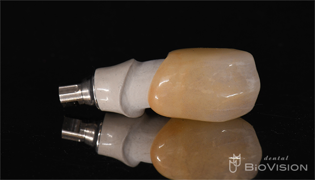 Maxillary anterior tooth cement retain monolithic zirconia