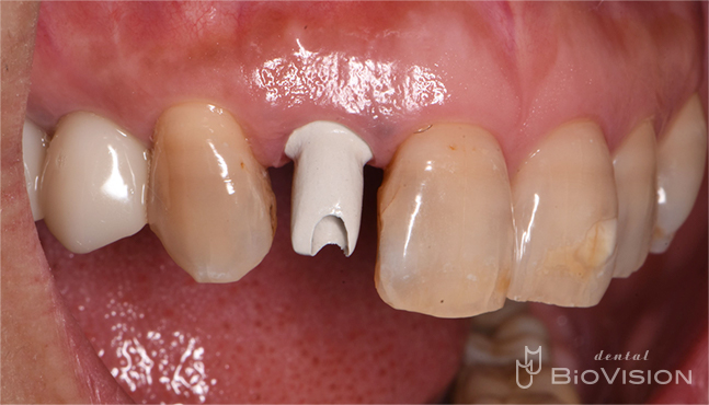Maxillary anterior tooth cement retain monolithic zirconia