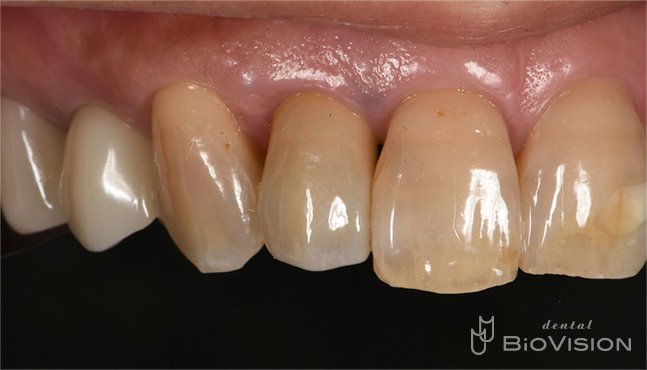 Maxillary anterior tooth cement retain monolithic zirconia