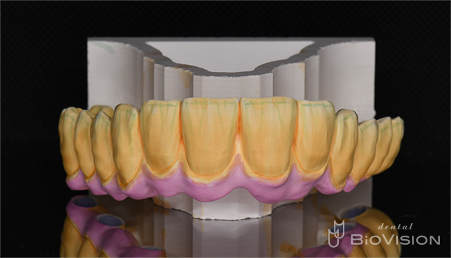 Screw Retained Full arch Monolithic Zirconia