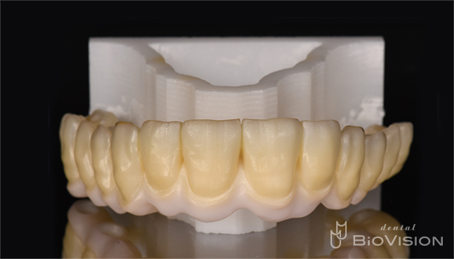 Screw Retained Full arch Monolithic Zirconia