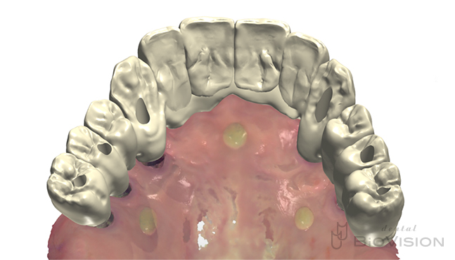 Screw Retained Full arch Monolithic Zirconia