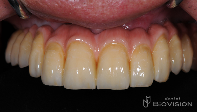 Screw Retained Full arch Monolithic Zirconia