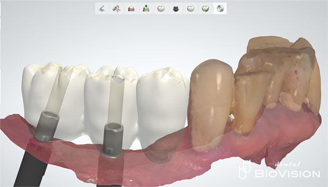 Screw Retained Full Anatomic Zirconia Br (Non Printer Model)