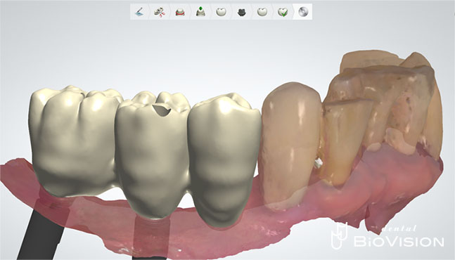 Screw Retained Full Anatomic Zirconia Br (Non Printer Model)