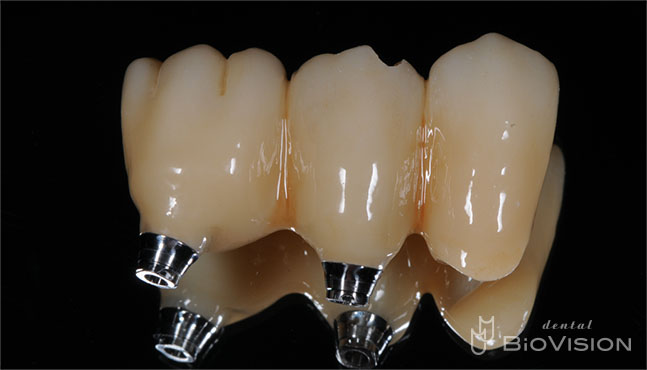 Screw Retained Full Anatomic Zirconia Br (Non Printer Model)