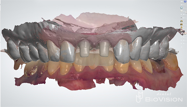 11 & 21 Pekkton Core and Monolithic Zirconia Crown