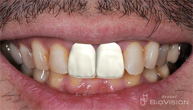 11 & 21 Pekkton Core and Monolithic Zirconia Crown