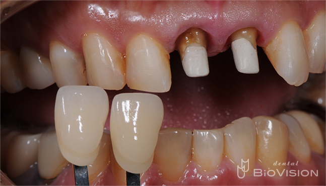 11 & 21 Pekkton Core and Monolithic Zirconia Crown