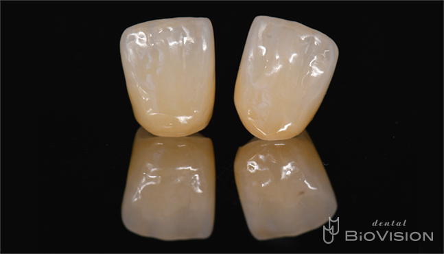 11 & 21 Pekkton Core and Monolithic Zirconia Crown