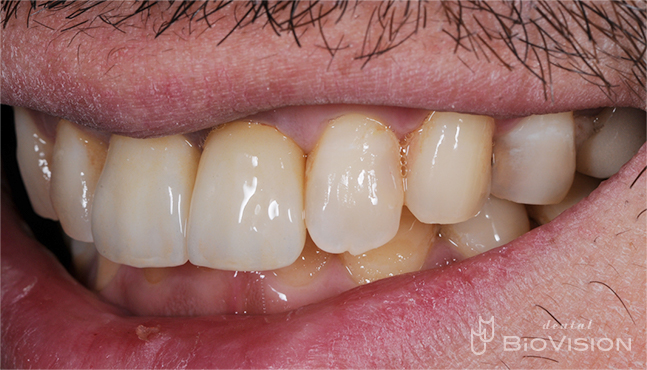 11 & 21 Pekkton Core and Monolithic Zirconia Crown